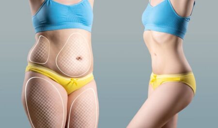 Belly Fat Removal Options for a Toned Body